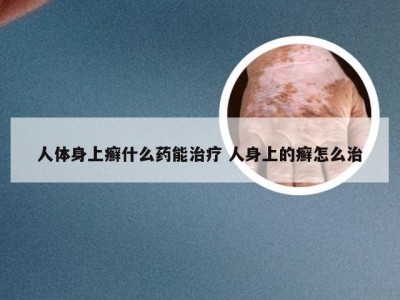 人体身上癣什么药能治疗 人身上的癣怎么治