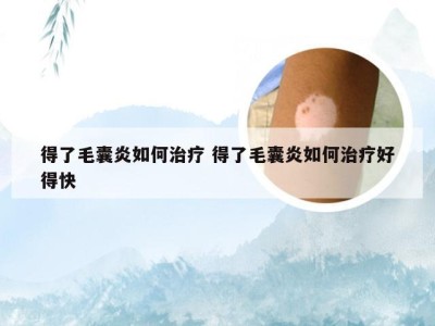 得了毛囊炎如何治疗 得了毛囊炎如何治疗好得快