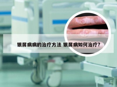 银屑病病的治疗方法 银屑病如何治疗?