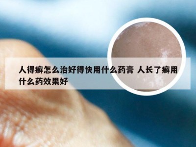 人得癣怎么治好得快用什么药膏 人长了癣用什么药效果好