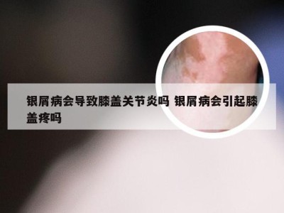 银屑病会导致膝盖关节炎吗 银屑病会引起膝盖疼吗