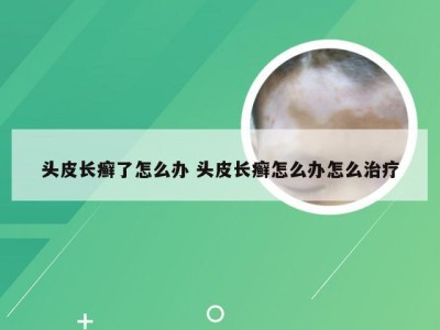 头皮长癣了怎么办 头皮长癣怎么办怎么治疗