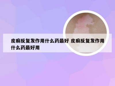 皮癣反复发作用什么药最好 皮癣反复发作用什么药最好用