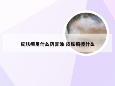 皮肤癣用什么药膏涂 皮肤癣擦什么