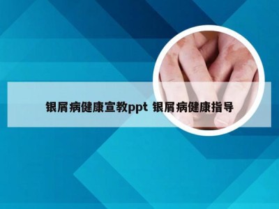 银屑病健康宣教ppt 银屑病健康指导