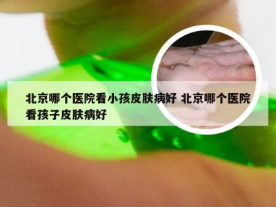 北京哪个医院看小孩皮肤病好 北京哪个医院看孩子皮肤病好