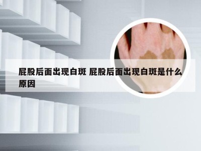 屁股后面出现白斑 屁股后面出现白斑是什么原因