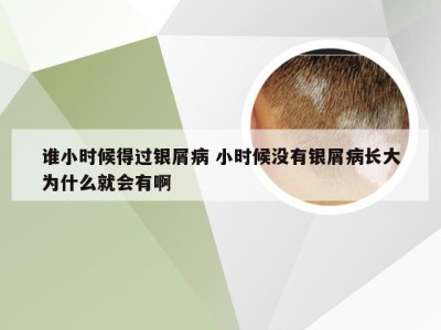 谁小时候得过银屑病 小时候没有银屑病长大为什么就会有啊