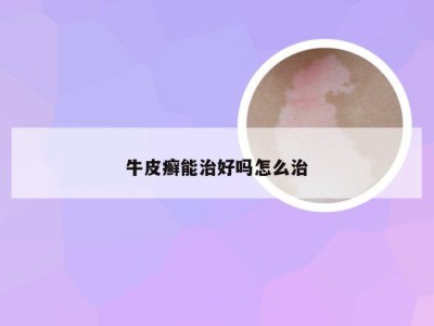 牛皮癣能治好吗怎么治