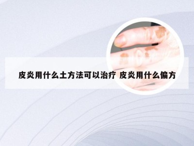 皮炎用什么土方法可以治疗 皮炎用什么偏方