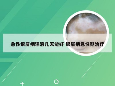 急性银屑病输液几天能好 银屑病急性期治疗