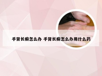 手背长癣怎么办 手背长癣怎么办用什么药