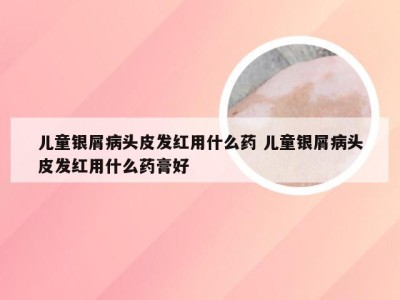 儿童银屑病头皮发红用什么药 儿童银屑病头皮发红用什么药膏好