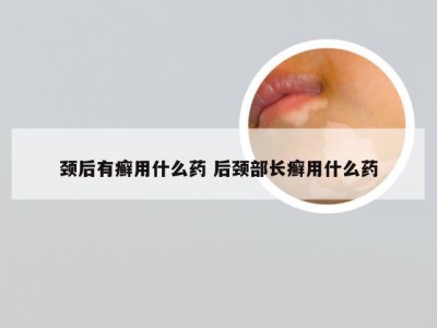 颈后有癣用什么药 后颈部长癣用什么药