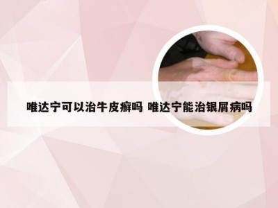 唯达宁可以治牛皮癣吗 唯达宁能治银屑病吗