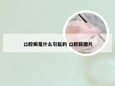 口腔癣是什么引起的 口腔藓图片