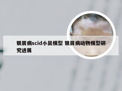 银屑病scid小鼠模型 银屑病动物模型研究进展