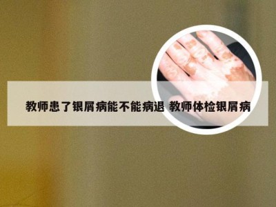 教师患了银屑病能不能病退 教师体检银屑病