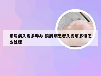 银屑病头皮多咋办 银屑病患者头皮屑多该怎么处理