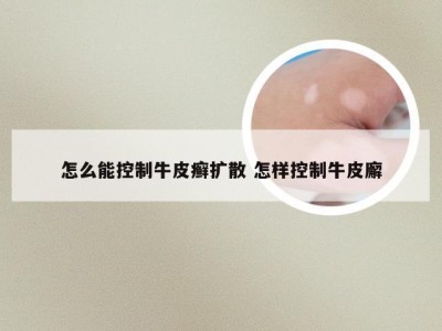 怎么能控制牛皮癣扩散 怎样控制牛皮廨