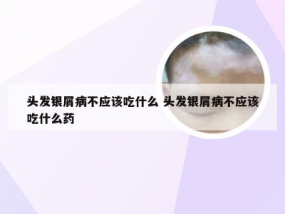 头发银屑病不应该吃什么 头发银屑病不应该吃什么药