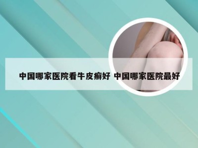 中国哪家医院看牛皮癣好 中国哪家医院最好