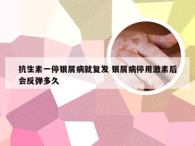 抗生素一停银屑病就复发 银屑病停用激素后会反弹多久