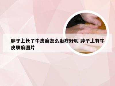 脖子上长了牛皮癣怎么治疗好呢 脖子上有牛皮肤癣图片