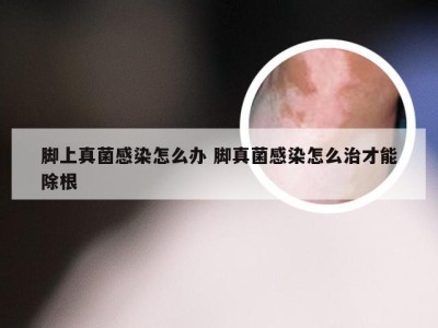 脚上真菌感染怎么办 脚真菌感染怎么治才能除根