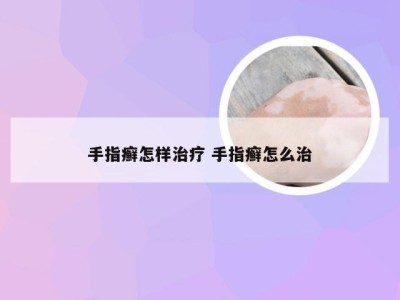 手指癣怎样治疗 手指癣怎么治