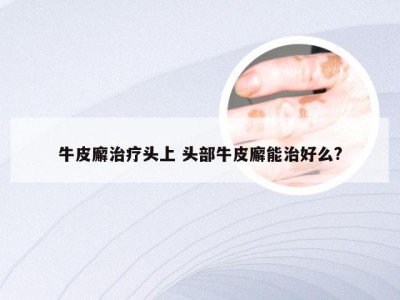 牛皮廨治疗头上 头部牛皮廨能治好么?