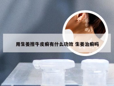 用生姜擦牛皮癣有什么功效 生姜治癣吗