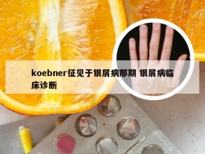 koebner征见于银屑病那期 银屑病临床诊断