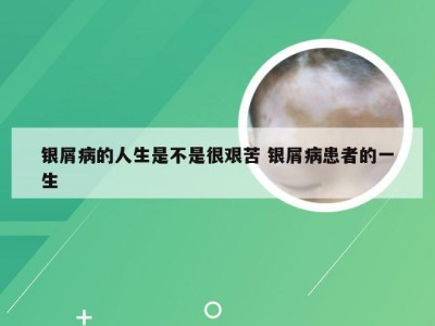 银屑病的人生是不是很艰苦 银屑病患者的一生