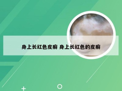 身上长红色皮癣 身上长红色的皮癣