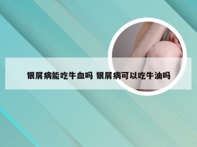 银屑病能吃牛血吗 银屑病可以吃牛油吗