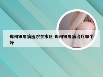 郑州银屑病医院金水区 郑州银屑病治疗哪个好