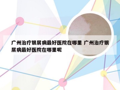 广州治疗银屑病最好医院在哪里 广州治疗银屑病最好医院在哪里呢