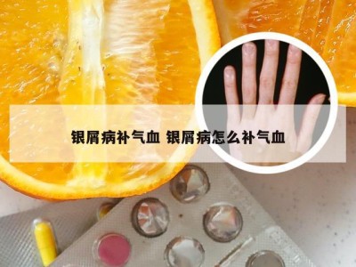 银屑病补气血 银屑病怎么补气血