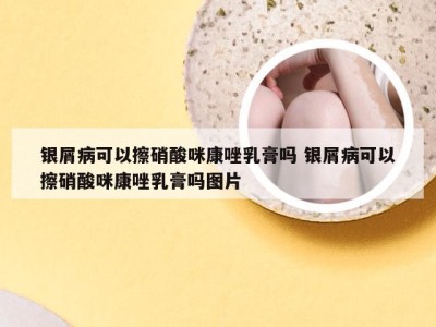 银屑病可以擦硝酸咪康唑乳膏吗 银屑病可以擦硝酸咪康唑乳膏吗图片