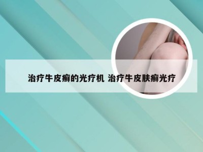 治疗牛皮癣的光疗机 治疗牛皮肤癣光疗