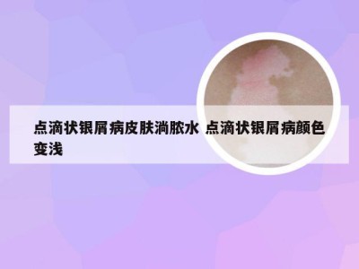 点滴状银屑病皮肤淌脓水 点滴状银屑病颜色变浅