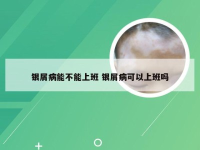 银屑病能不能上班 银屑病可以上班吗