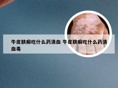 牛皮肤癣吃什么药清血 牛皮肤癣吃什么药清血毒