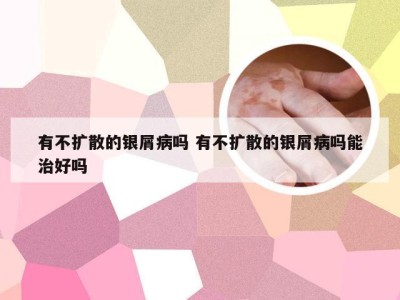 有不扩散的银屑病吗 有不扩散的银屑病吗能治好吗