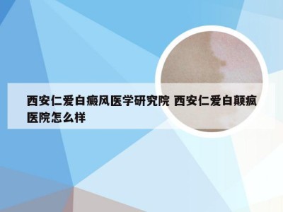 西安仁爱白癜风医学研究院 西安仁爱白颠疯医院怎么样