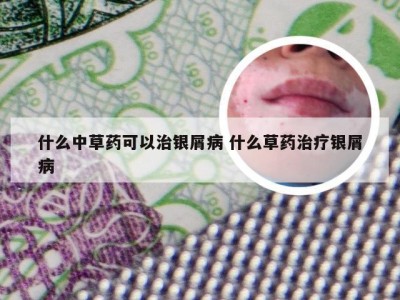 什么中草药可以治银屑病 什么草药治疗银屑病