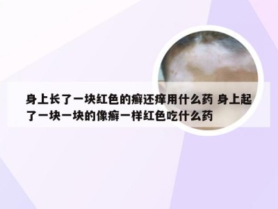 身上长了一块红色的癣还痒用什么药 身上起了一块一块的像癣一样红色吃什么药