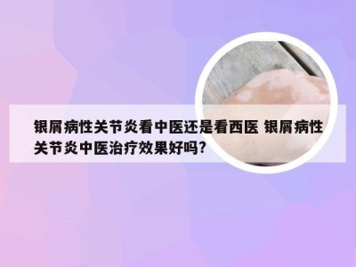 银屑病性关节炎看中医还是看西医 银屑病性关节炎中医治疗效果好吗?