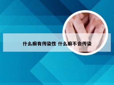 什么癣有传染性 什么癣不会传染